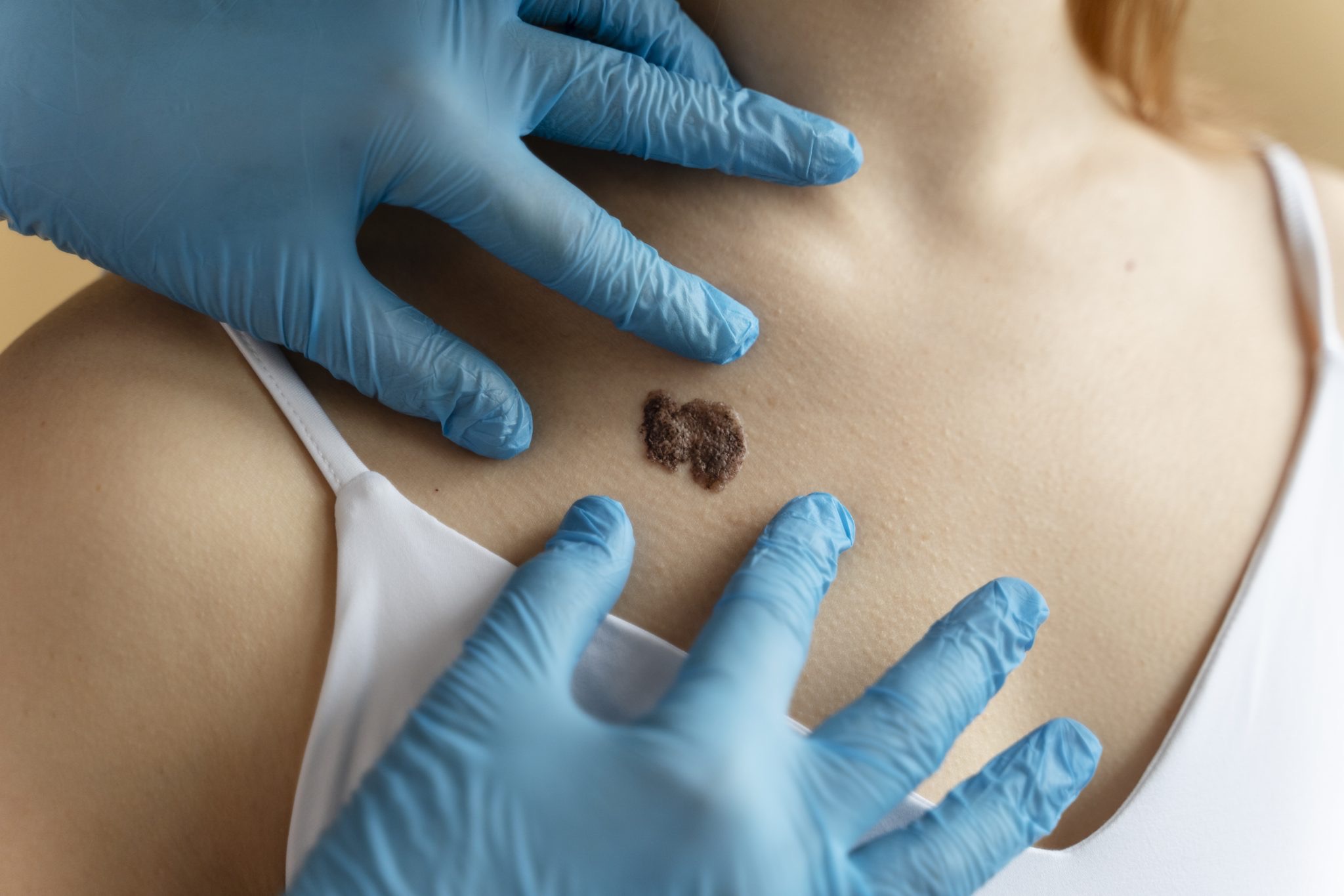 El extracto de cannabis ha demostrado ser efectivo en la lucha contra el c&aacute;ncer de piel (melanoma)